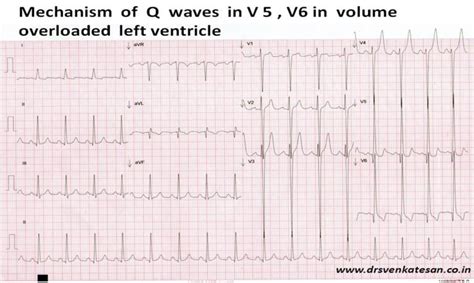 lv overload|lv overload on ekg.